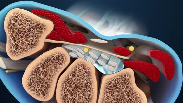 Carpal tunnel syndrome is when the median nerve is compressed as it passes through the carpal tunnel alt