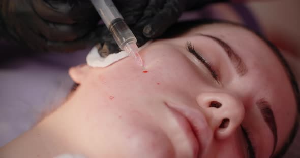 Beautician Does Injections to the Woman's Face Botox and Hyaluronic Acid Rejuvenating Beauty