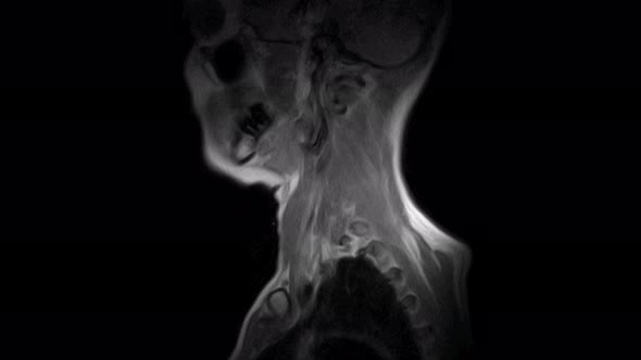 MRI of the Cervical Spine, Detection of Protrusions and Hernias alt
