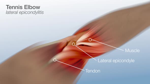 Tennis Elbow - Lateral Epicondylitis