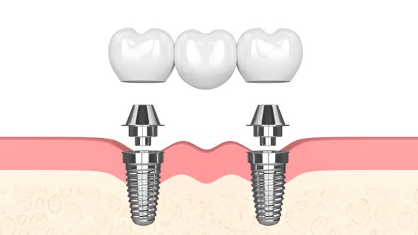 Gums with implants with dental bridge 