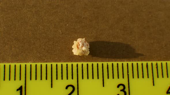 Top View Oxalate Stone From A Human Kidney Close Up, Measure The Size Of The Stone With A Ruler