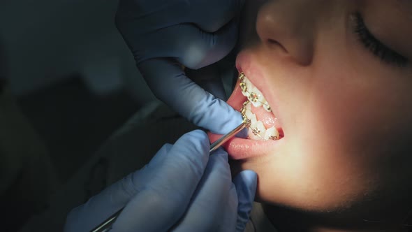 Installation and Fixing of Metal Braces on the Teeth Teen Girl alt