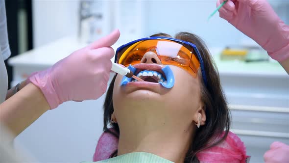 Dentist Applies A Whitening Gel On Tooth Patient.