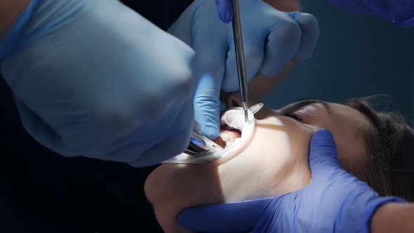 Dentist Using Surgical Pliers to Extract a Tooth in the Dental Office