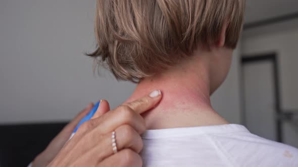 Red Pustules and Vesicles on the Skin of the Neck As Symptoms of Photodermatitis alt