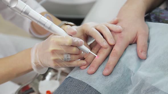 Removal of Warts Laser on the Fingers. Close-up alt