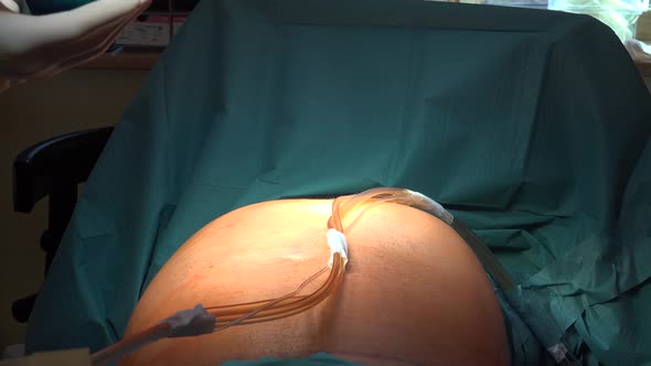 Liposuction and Belly Fat