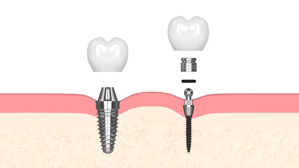 Comparison of two types dental implants