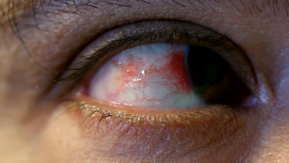 Man Blinking Red Bloody Annoyed Eye