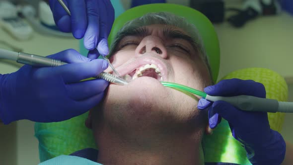 Dentist Drilling Tooth of Patient. Dentist Hands Working in Open Oral Cavity alt