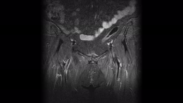 Postoperative MRI of Female Organs for the Detection of Metastases alt