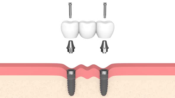 Dental bridge supported by implants installed in human gums