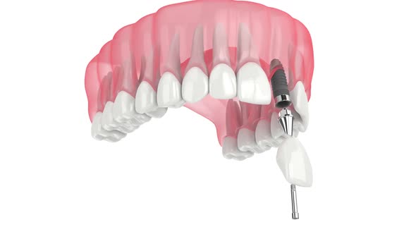 upper jaw with incisor dental implant placement over white background