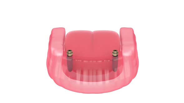 Bar retained removable overdenture installation supported by two implants