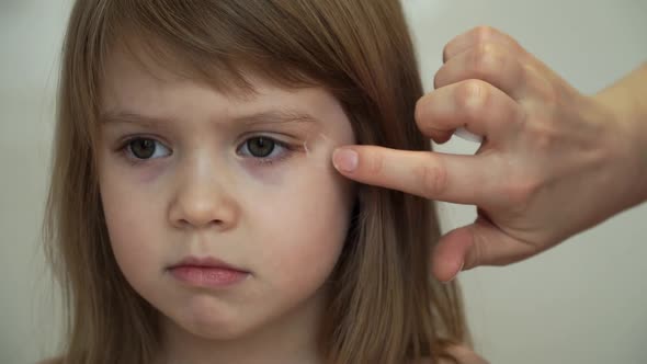 Mothers Hands Smear Bruise on Eye of Girl Antiphlogistic Ointment