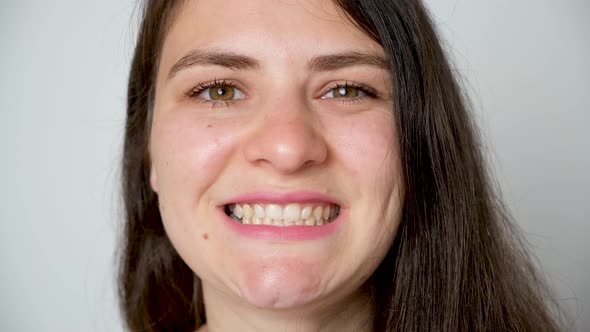 Patient with Dislocated Jaw and Malocclusion Temporomandibular Joint Dysfunction alt