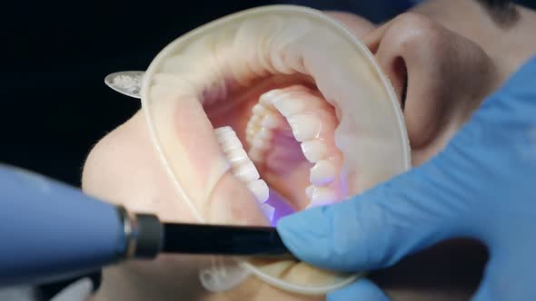 Dentist Makes a Procedure for Teeth Whitening
