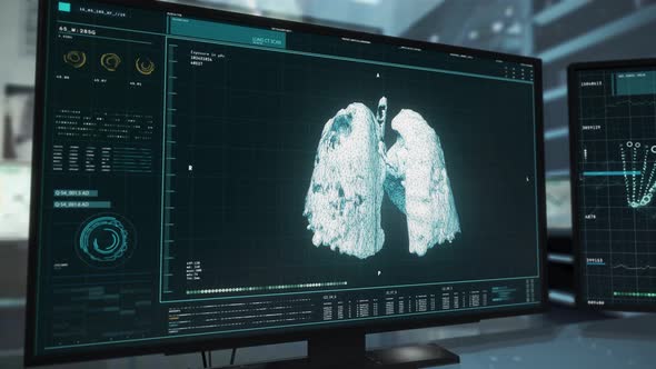 Finding Traces of the Covid-19 Pneumonia Disease inside of the Patient`s Lungs alt