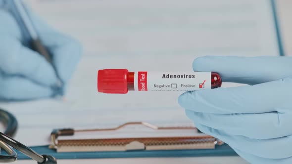 The Doctor Holds Hand Blood Sample Positive with Adenovirus alt