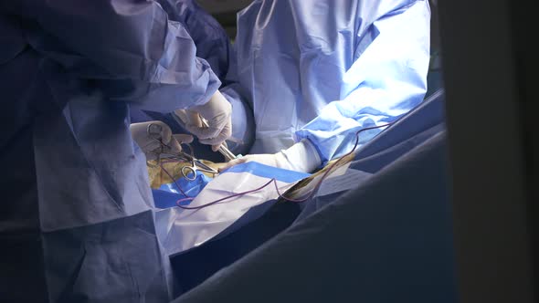 Surgeons working during surgery, close up on hands and instruments. alt