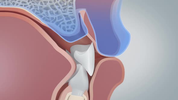 If the gums recede too much, it can cause bone loss that can cause teeth to loosen or fall out. alt