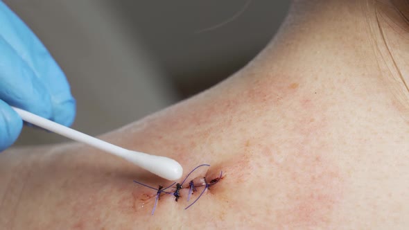 A Doctor Treats a Wound on a Woman's Shoulder alt