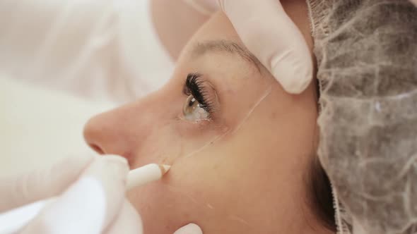 Doctor Marks Facial Zones Before Injection alt