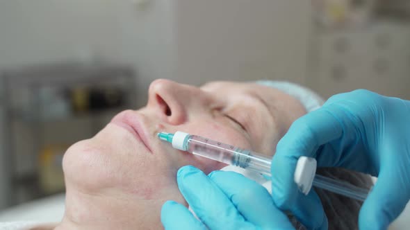 The Cosmetologist Makes an Injection of Hyaluronic Acid Into the Skin of the Face of an Adult Woman alt