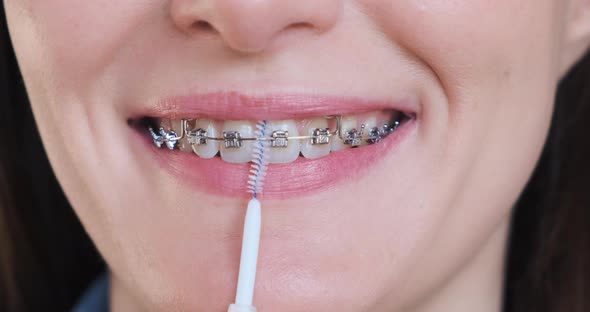 Collage Cleaning Braces Teeth Closeup alt