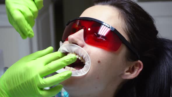 Closeup View of the Dentist's Hands Putting Rubber Dam in a Mouth of a Female Patient alt