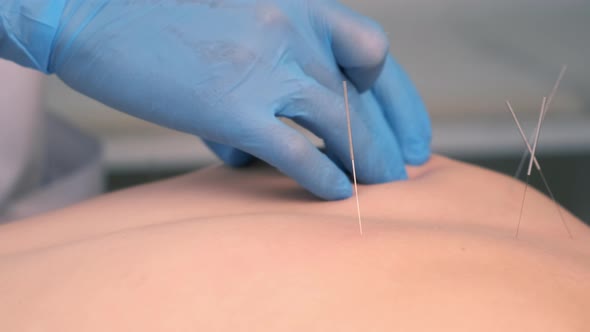 Hands Doctor Acupuncturist Inserts Acupuncture Needles To Woman's Back
