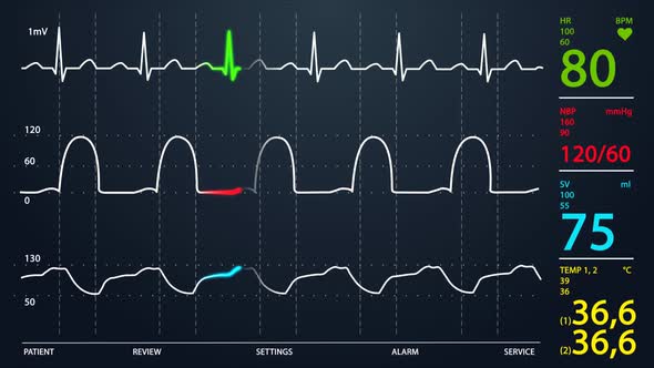Animation of Intensive Care Unit monitor showing normal values for vital signs. alt