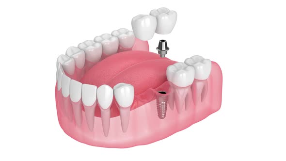 jaw-with-implant-supported-dental-cantilever-bridge-isolated-over-white