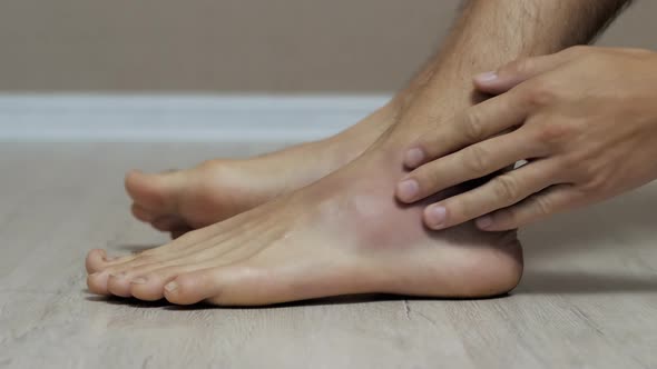 Man Touches His Foot with a Big Bruise Sprain and Injury alt