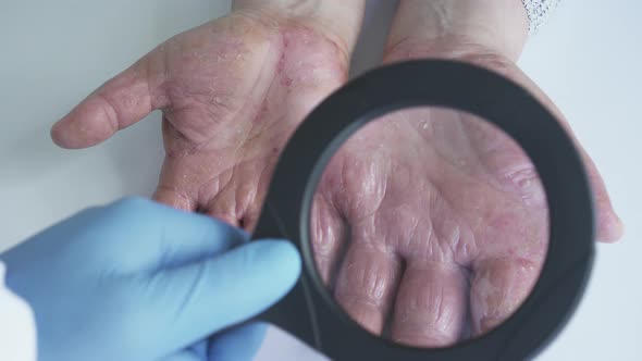 The doctor examine Dermatitis sore skin use a magnifying glass. Allergy Diabetes Eczema