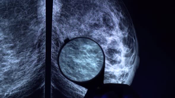 Doctor with magnifying glass checking mammogram x-ray.