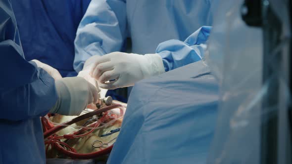 Surgeons working during open heart surgery, close up on hands and instruments. alt