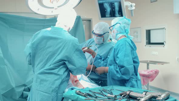 Group of Doctors are Performing a Surgery on Patient's Leg alt