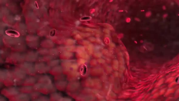 Plaques accumulating in the blood block the coronary arteries alt