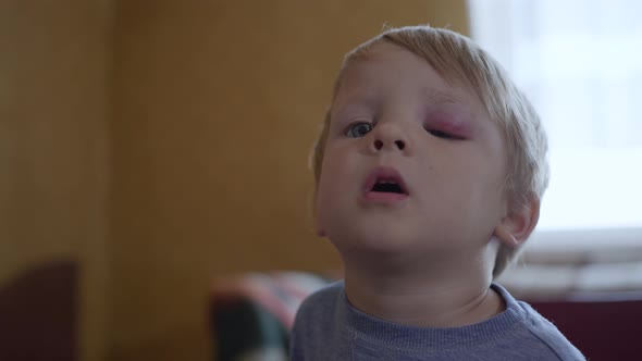 Small Male Child with an Injury or a Bruise on His Face Cannot Open His Eyes Due To Swelling and alt