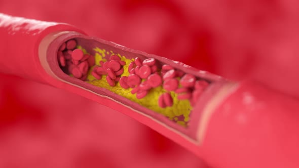 a Blood Clot Clogs a Vessel Affected By a Cholesterol Plaque Cross Section View