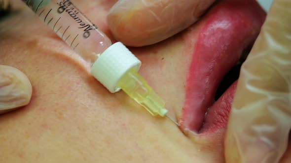 The Cosmetologist Makes Injections on the Client's Face in the Lip Area
