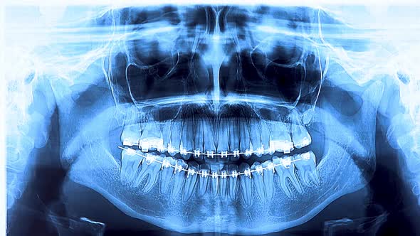 Dental Radiography with Braces