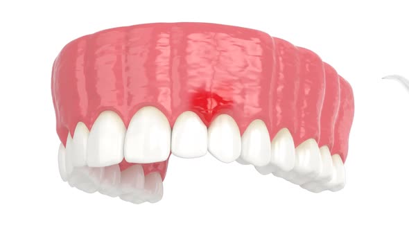 Dental diode laser used to treat gums