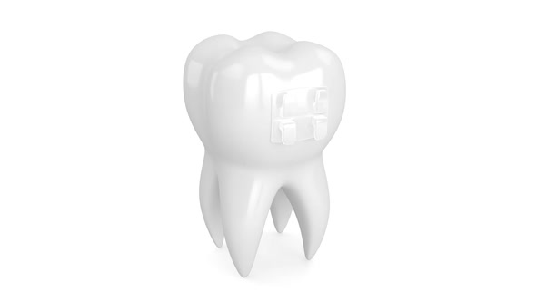 Tooth with orthodontic ceramic braces