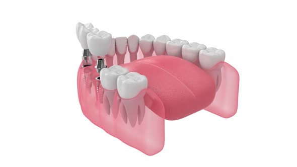 Jaw and implants supporting dental bridge 