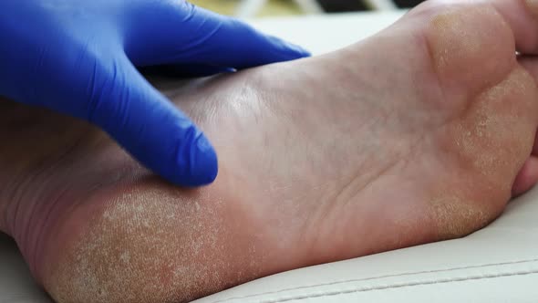 The Doctor Diagnoses The Injured Foot. Dry Skin, Psoriasis Of The Feet. The Skin Is Damaged.