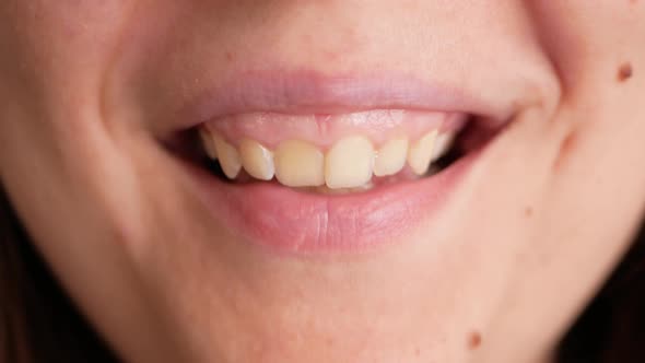 Person Smiles Shows Teeth Yellow Plaque Crooked Teeth Malocclusion