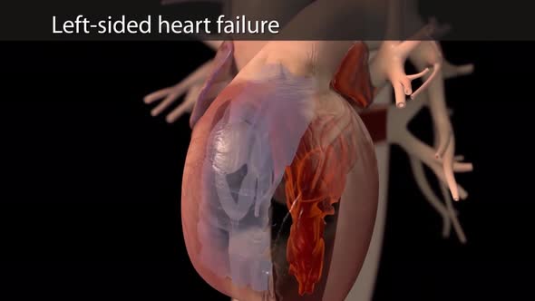 Left-sided heart failure Animated Congestive Heart Failure alt